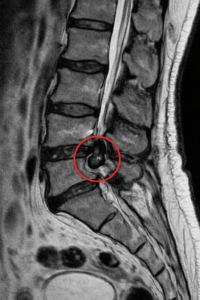 横浜整体 脊柱管狭窄症
